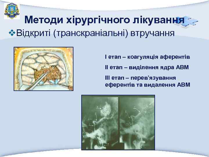 Методи хірургічного лікування v. Відкриті (транскраніальні) втручання І етап – коагуляція аферентів ІІ етап