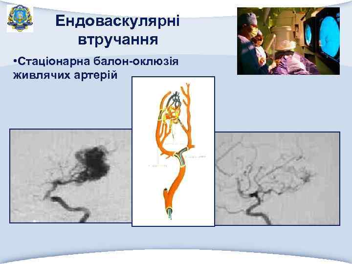 Ендоваскулярні втручання • Стаціонарна балон-оклюзія живлячих артерій 