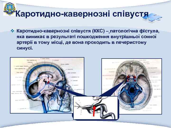 Каротидно-кавернозні співустя v Каротидно-кавернозні співустя (ККС) – патологічна фістула, яка виникає в результаті пошкодження