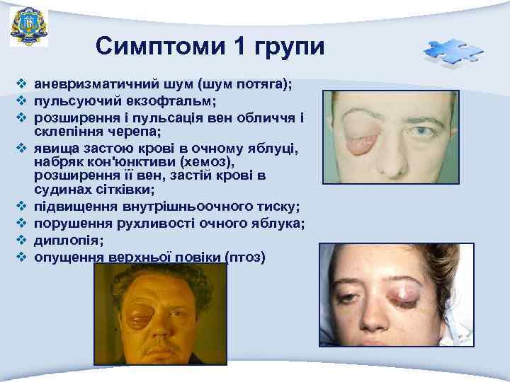 Симптоми 1 групи v аневризматичний шум (шум потяга); v пульсуючий екзофтальм; v розширення і