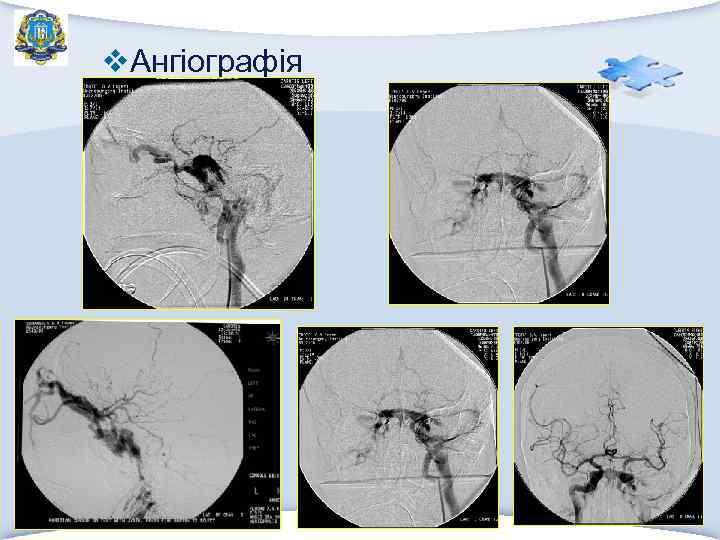 v. Ангіографія 