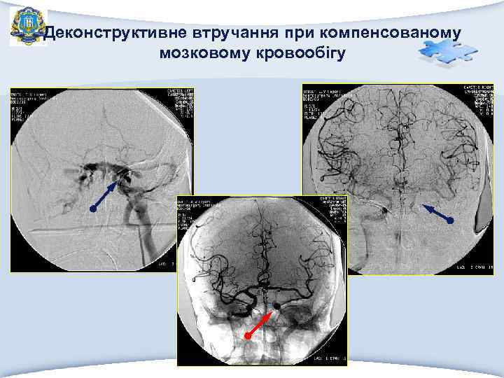 Деконструктивне втручання при компенсованому мозковому кровообігу 
