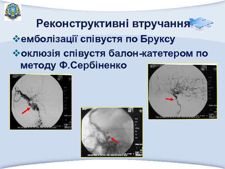 Реконструктивні втручання vемболізації співустя по Бруксу vоклюзія співустя балон-катетером по методу Ф. Сербіненко 