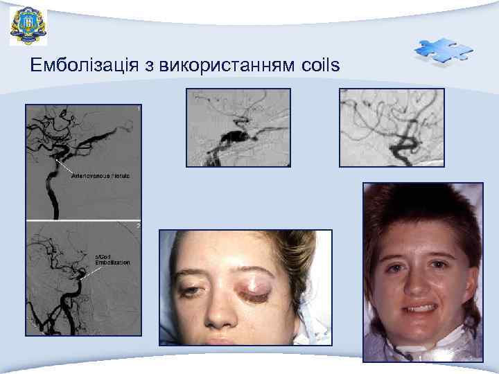 Емболізація з використанням coils 