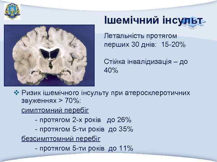 Ішемічний інсульт Летальність протягом перших 30 днів: 15 -20% Стійка інвалідизація – до 40%