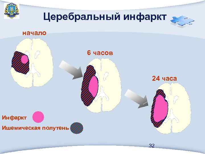 Церебральный инфаркт начало 6 часов 24 часа Инфаркт Ишемическая полутень 32 