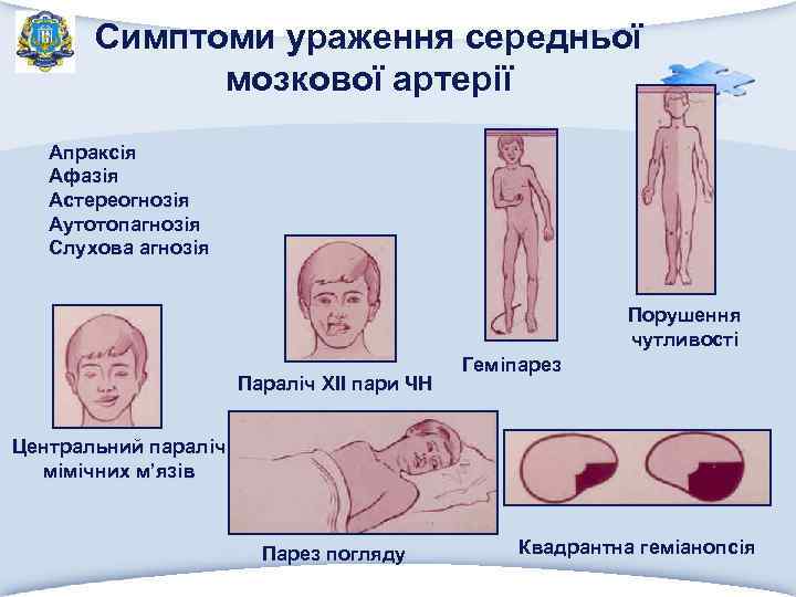 Симптоми ураження середньої мозкової артерії Апраксія Афазія Астереогнозія Аутотопагнозія Слухова агнозія Порушення чутливості Параліч