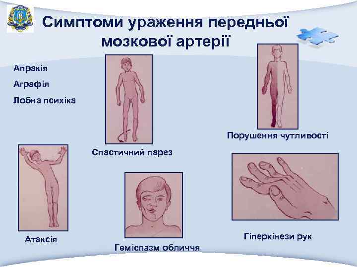 Симптоми ураження передньої мозкової артерії Апракія Аграфія Лобна психіка Порушення чутливості Спастичний парез Атаксія