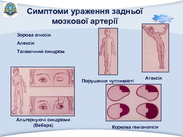 Симптоми ураження задньої мозкової артерії Зорова агнозія Алексія Таламічний синдром Порушення чутливості Альтернуючі синдроми