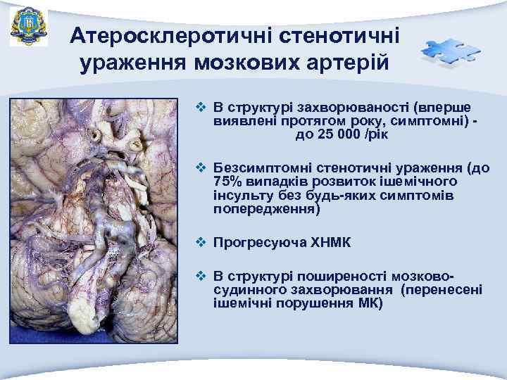 Атеросклеротичні стенотичні ураження мозкових артерій v В структурі захворюваності (вперше виявлені протягом року, симптомні)