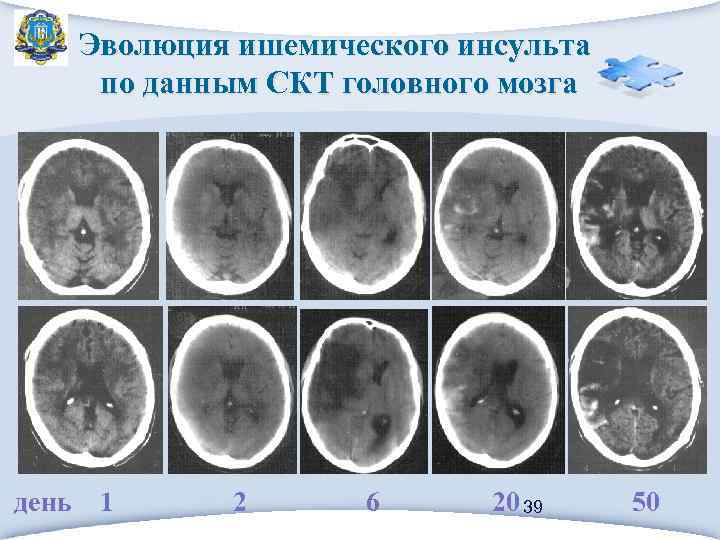 Эволюция ишемического инсульта по данным СКТ головного мозга день 1 2 6 20 39