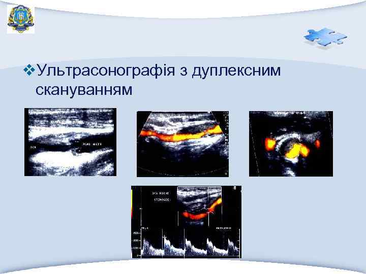 v. Ультрасонографія з дуплексним скануванням 