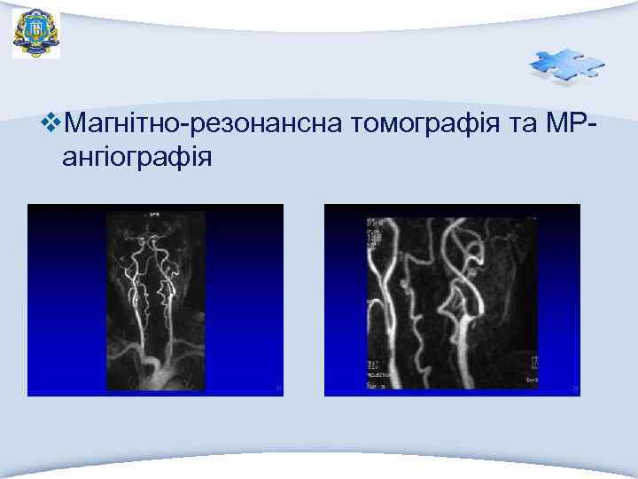 v. Магнітно-резонансна томографія та МРангіографія 
