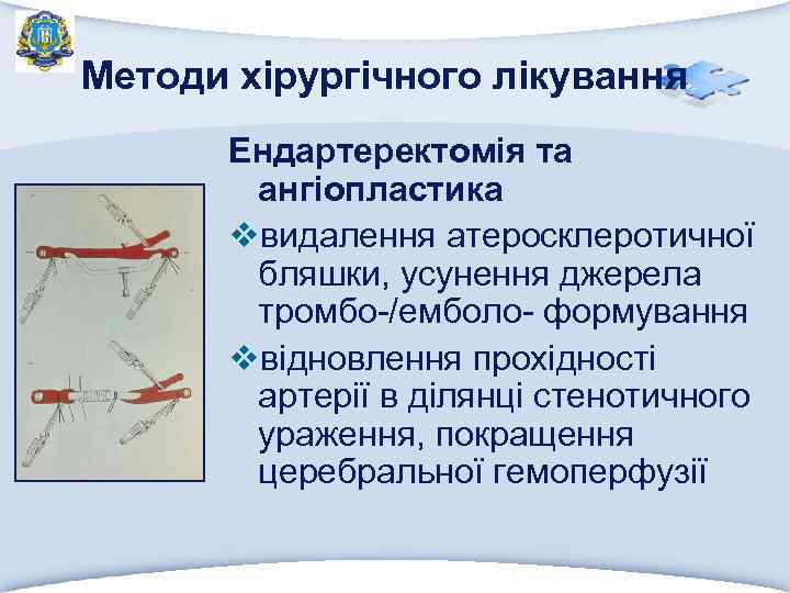 Методи хірургічного лікування Ендартеректомія та ангіопластика vвидалення атеросклеротичної бляшки, усунення джерела тромбо-/емболо- формування vвідновлення