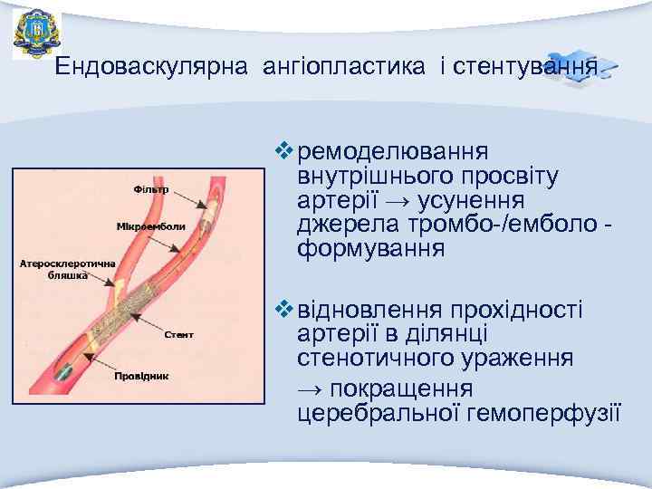 Ендоваскулярна ангіопластика і стентування v ремоделювання внутрішнього просвіту артерії → усунення джерела тромбо-/емболо формування