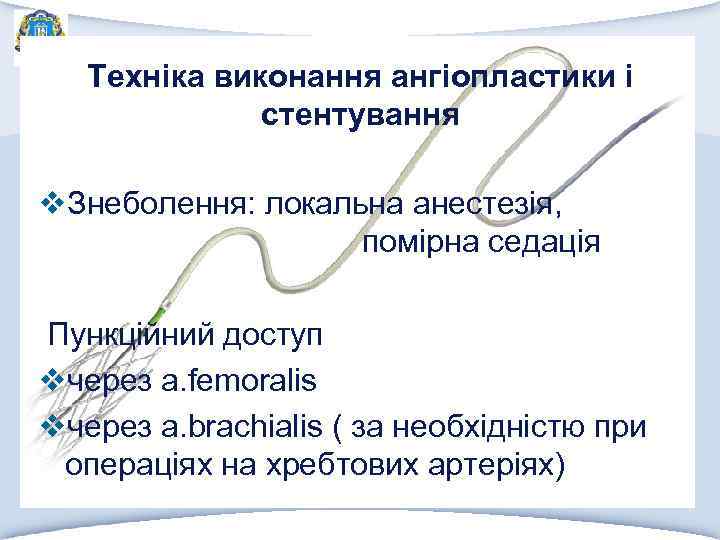 Техніка виконання ангіопластики і стентування v. Знеболення: локальна анестезія, помірна седація Пункційний доступ vчерез