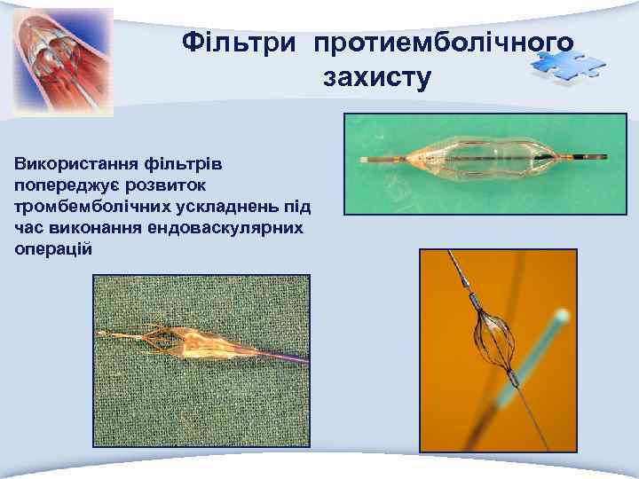 Фільтри протиемболічного захисту Використання фільтрів попереджує розвиток тромбемболічних ускладнень під час виконання ендоваскулярних операцій