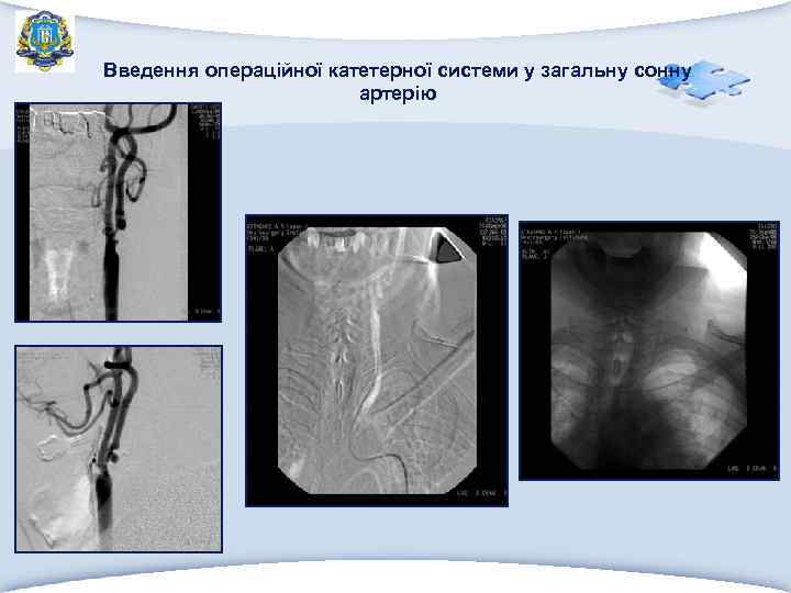 Введення операційної катетерної системи у загальну сонну артерію 
