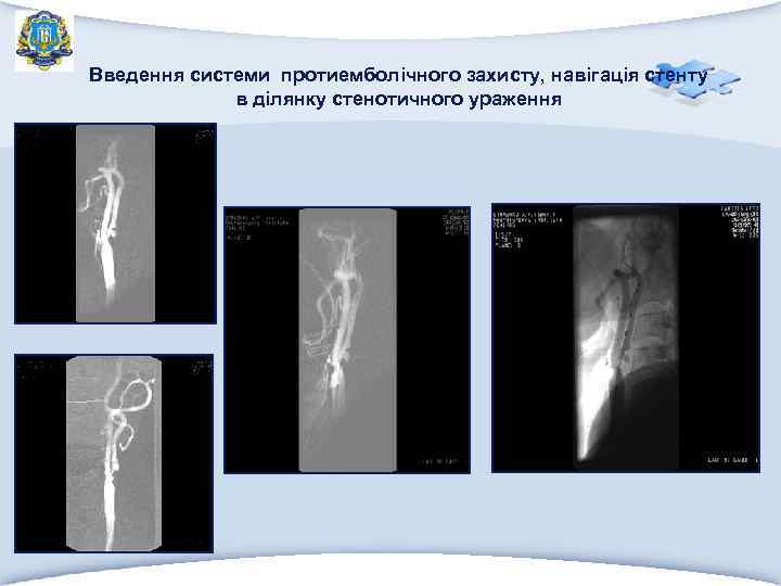 Введення системи протиемболічного захисту, навігація стенту в ділянку стенотичного ураження 