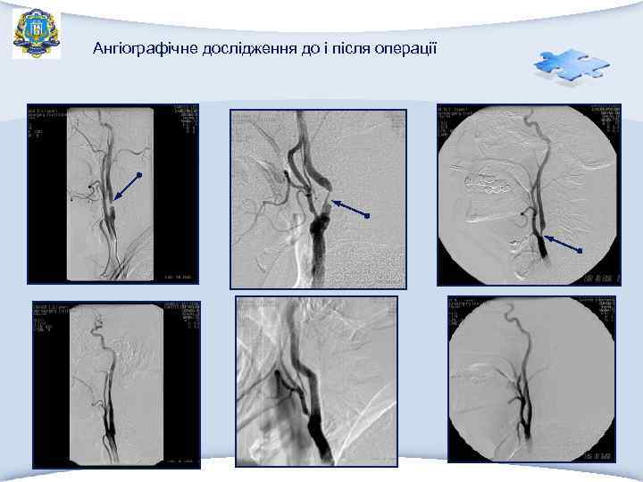 Ангіографічне дослідження до і після операції 