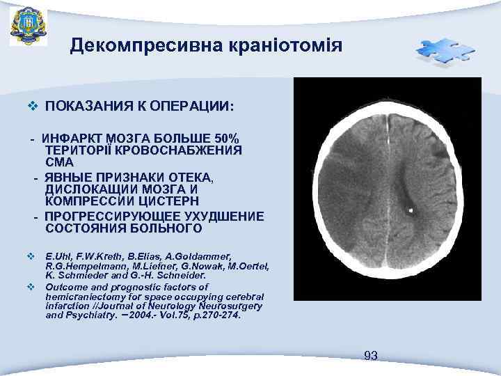 Декомпресивна краніотомія v ПОКАЗАНИЯ К ОПЕРАЦИИ: - ИНФАРКТ МОЗГА БОЛЬШЕ 50% ТЕРИТОРІЇ КРОВОСНАБЖЕНИЯ СМА