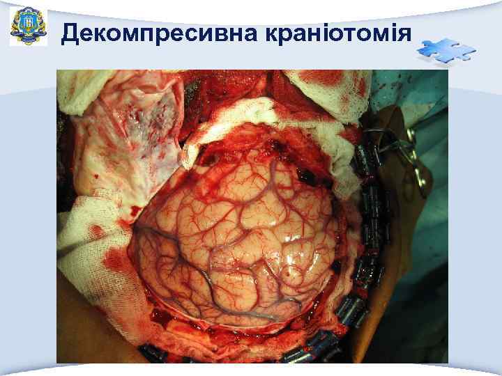 Декомпресивна краніотомія 