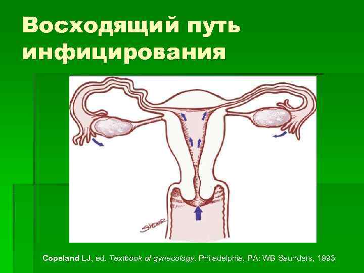Восходящий путь инфицирования Copeland LJ, ed. Textbook of gynecology. Philadelphia, PA: WB Saunders, 1993