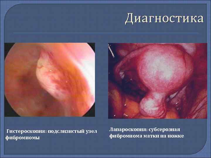     Диагностика Гистероскопия: подслизистый узел  Лапароскопия: субсерозная фибромиомы  