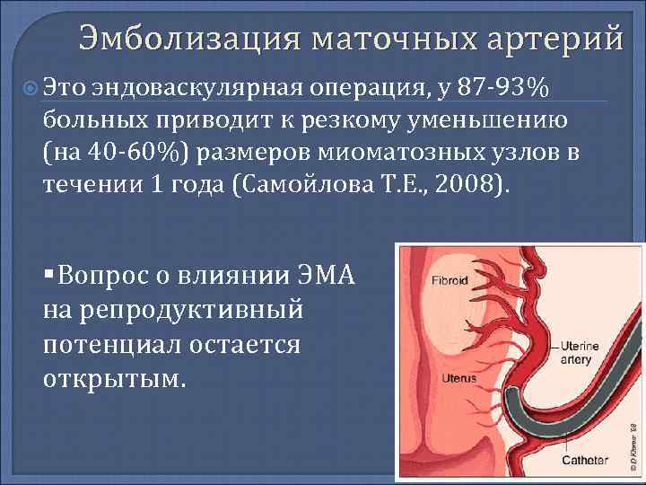 Эмболизация сосудов матки. Эмболизация ветвей маточных артерий. Эндоваскулярная эмболизация маточных артерий. Эмболизация маточных артерий при миоме матки.