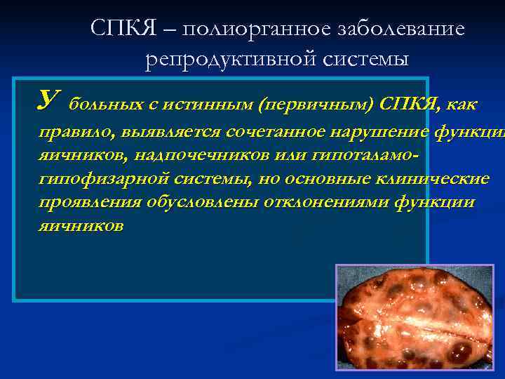 Синдром поликистозных яичников гинекология презентация