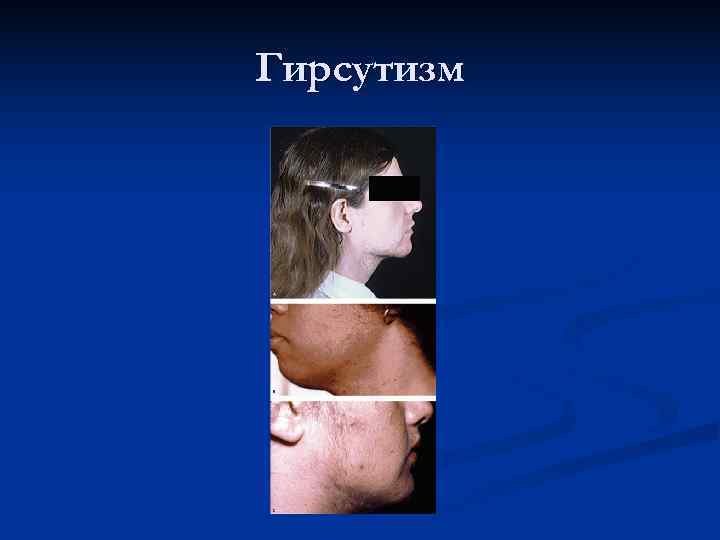 Гирсутизм Гирсутизм