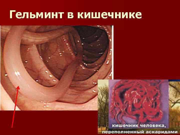 Гельминт в кишечнике 
