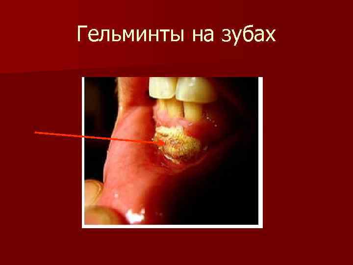 Гельминты на зубах 
