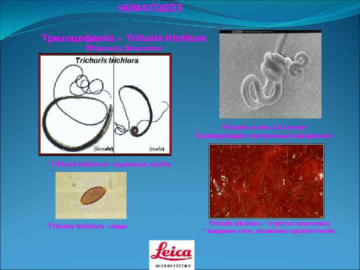     НЕМАТОДОЗ  Трихоцефалёз – Trihuris trichiura   Whipworm, Власоглав