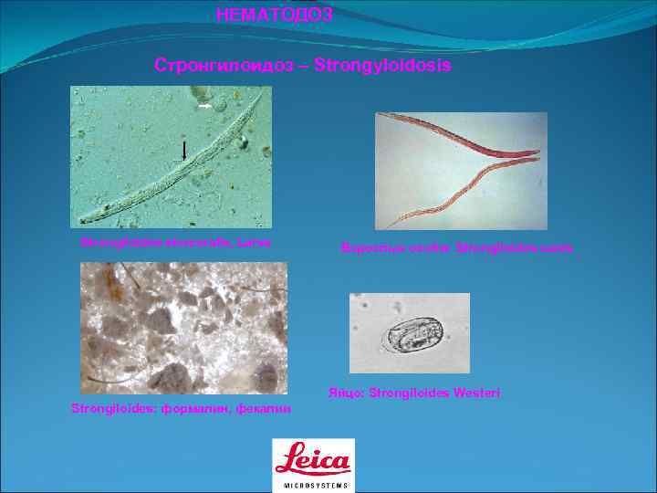     НЕМАТОДОЗ    Стронгилоидоз – Strongyloidosis Strongiloides stercoralis, Larva