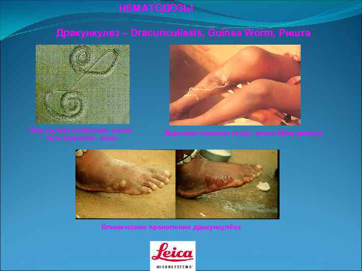      НЕМАТОДОЗЫ   Дракункулез – Dracunculiasis, Guinea Worm, Ришта