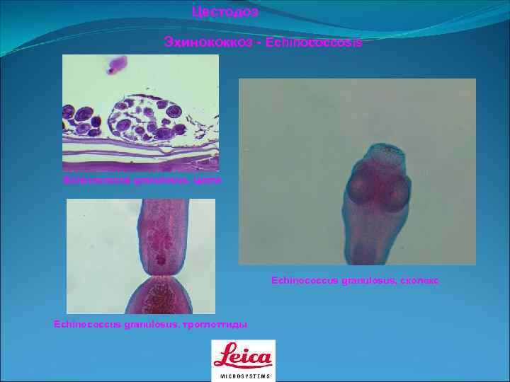      Цестодоз     Эхинококкоз - Echinococcosis Echinococcus