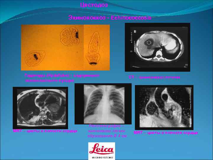       Цестодоз     Эхинококкоз - Echinococcosis