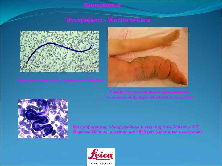      Филяриатоз    Вухерериоз - Wuchereriosis Wuchereria bancrofti,