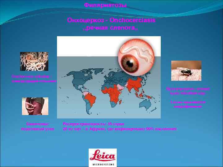        Филяриатозы      Онхоцеркоз