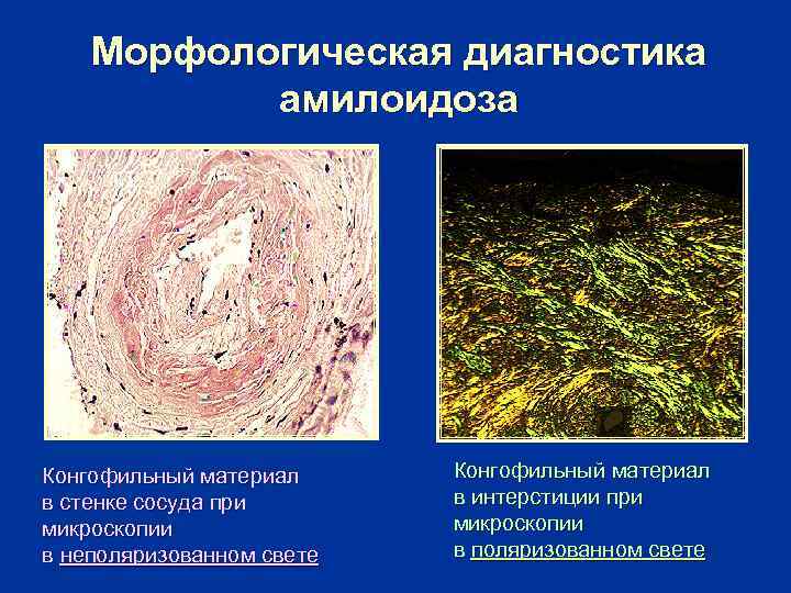   Морфологическая диагностика  амилоидоза Конгофильный материал в стенке сосуда при  в
