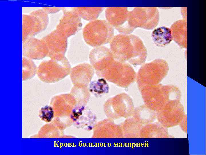 Кровь больного малярией Кровь больного малярией