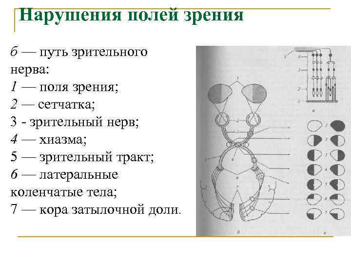  Нарушения полей зрения б — путь зрительного нерва: 1 — поля зрения; 2