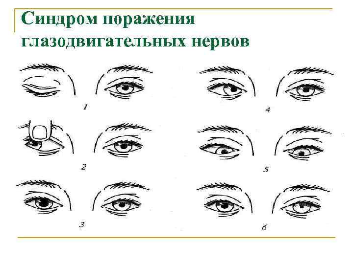 Синдром поражения глазодвигательных нервов 