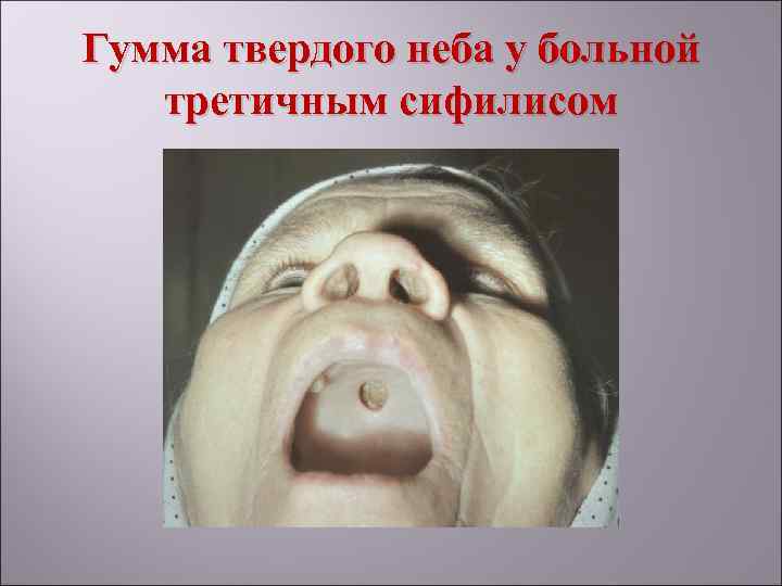 Гумма твердого неба у больной  третичным сифилисом 