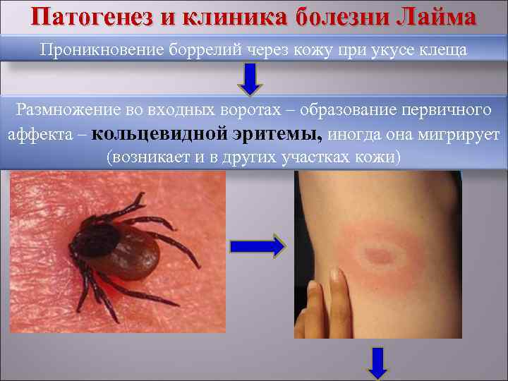  Патогенез и клиника болезни Лайма  Проникновение боррелий через кожу при укусе клеща
