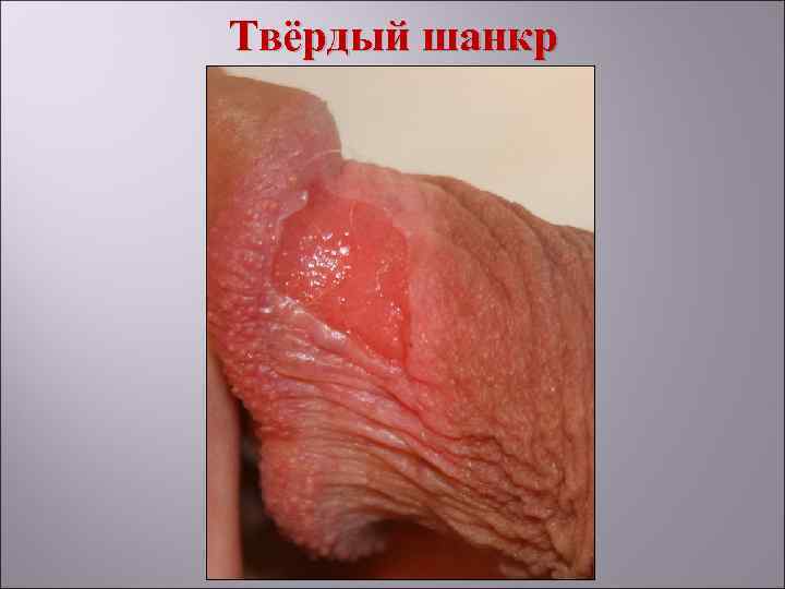 Твёрдый шанкр 