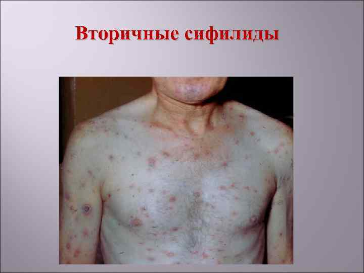 Вторичные сифилиды 
