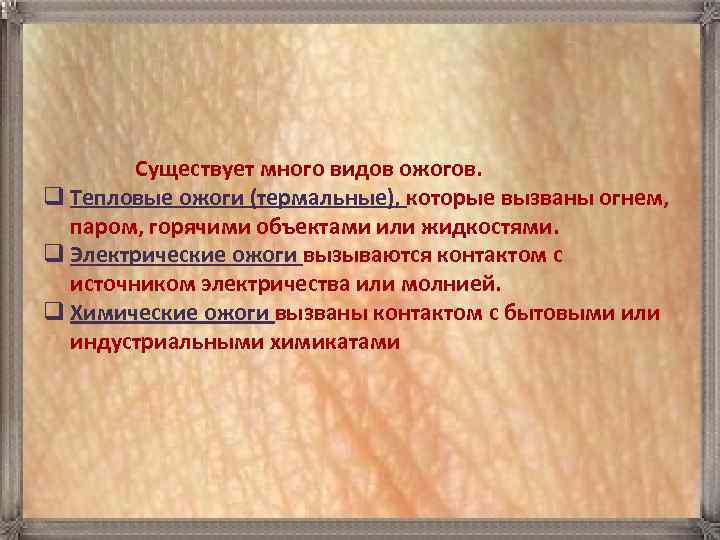    Существует много видов ожогов. q Тепловые ожоги (термальные), которые вызваны огнем,