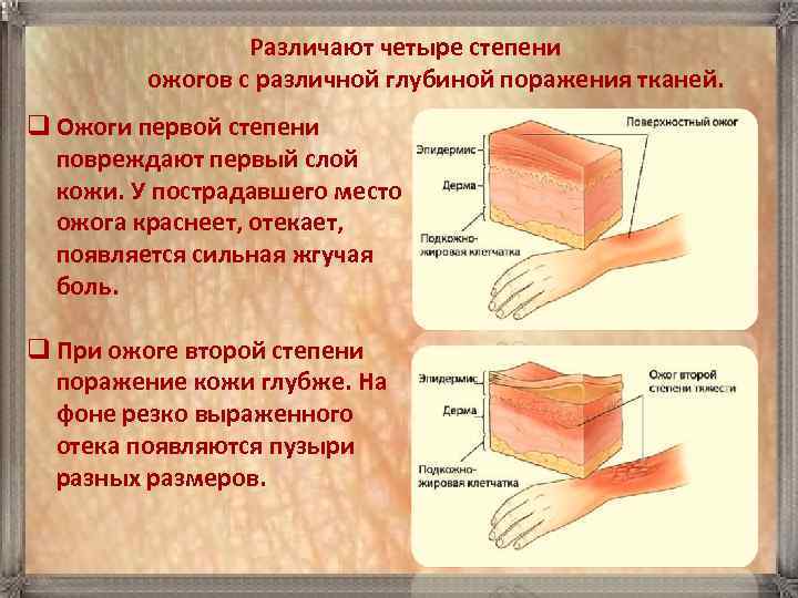      Pазличают четыре степени  ожогов с различной глубиной поражения